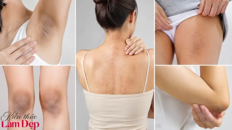 Deep L-Picosure hỗ trợ cải thiện nhiều dạng thâm sạm