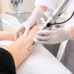 Có Nên Trị Thâm Body Bằng Deep L-Picosure Không?