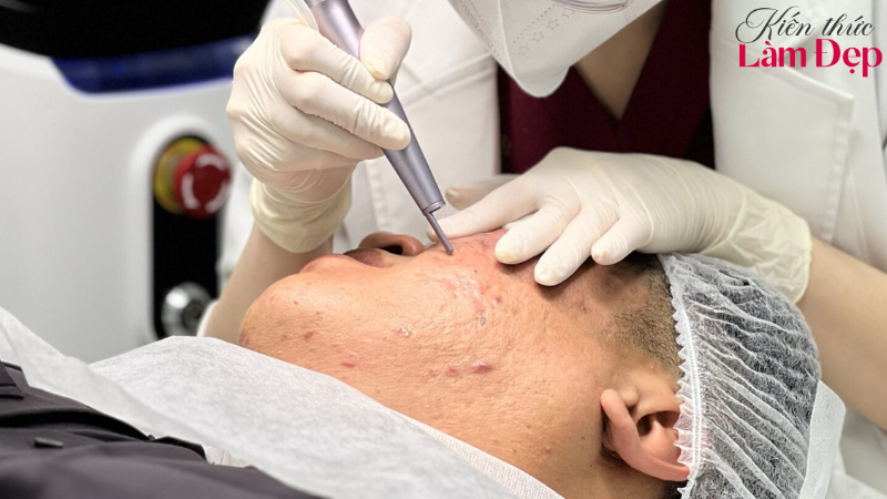 Số buổi điều trị Dermaperfecta tùy tình trạng da