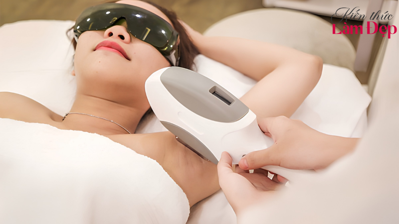 Công nghệ triệt lông Nano Laser cho làn da mịn màng