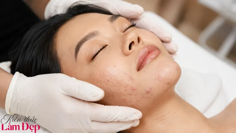 Doctor 4 Treatment cải thiện đa dạng tình trạng mụn