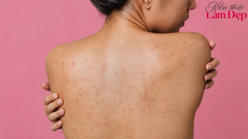 Dr. Peel nhau thai cừu hỗ trợ cải thiện nhiều dạng thâm sạm