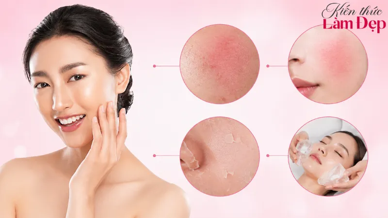 Sau khi Peel da nhiều trường hợp da sẽ bong tróc nhẹ