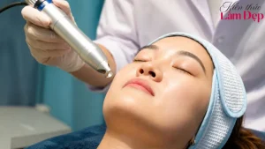 Tất Tần Tật Về Pico Melasma – Công Nghệ Trị Nám Đang Được Quan Tâm Hiện Nay