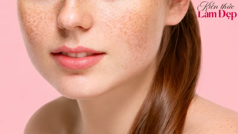 Công nghệ Pico Melasma ứng dụng cho tình trạng nám nào?