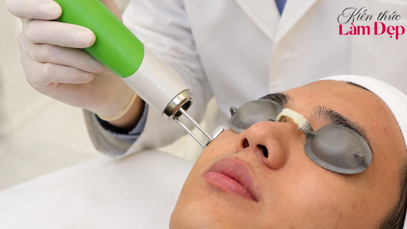 Deep L-Picosure, Laser Q-Switched có sự khác biệt về xung laser