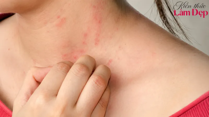 Da nổi mề đai không phù hợp với liệu trình White Herbs