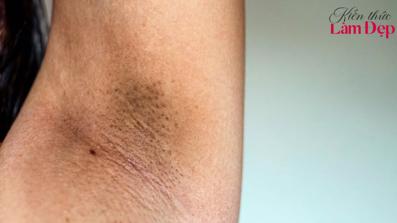 Deep L-Picosure phù hợp với nhiều tình trạng thâm từ mới hình thành đến lâu năm
